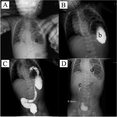 Laparoscopic repair of intrathoracic kidney associated with giant congenital diaphragmatic hernia: an infant case report and literature review